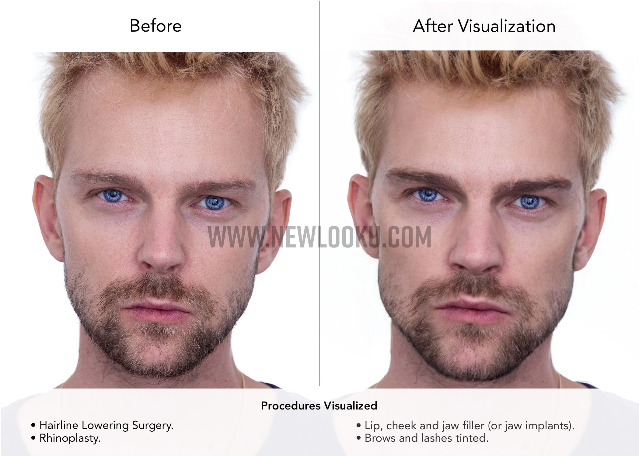 30 year old man Plastic Surgery Simulation Before & After Photo.